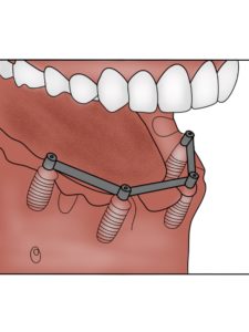 Bar Attachment Denture