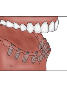 Screw Retained Denture