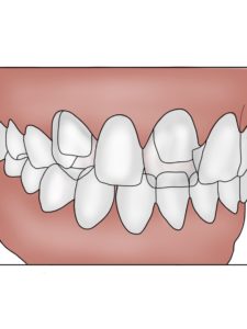 Replacing Missing Teeth Dental Bridge