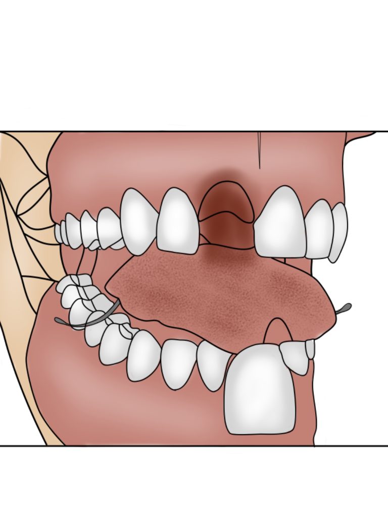 replacingmissingteeth2flipper Dental Specialists of South Loop