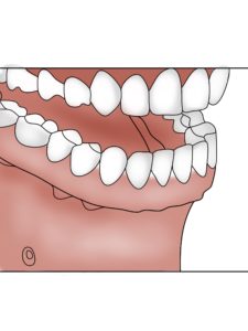 Replacing Missing Teeth Denture