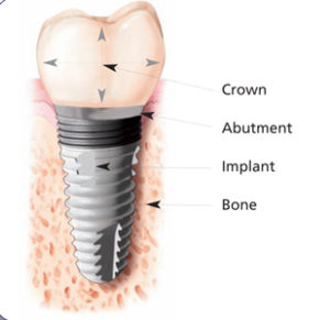 Dental Implants Glenview
